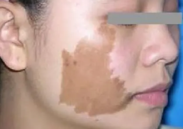 除胎记的方法有哪些